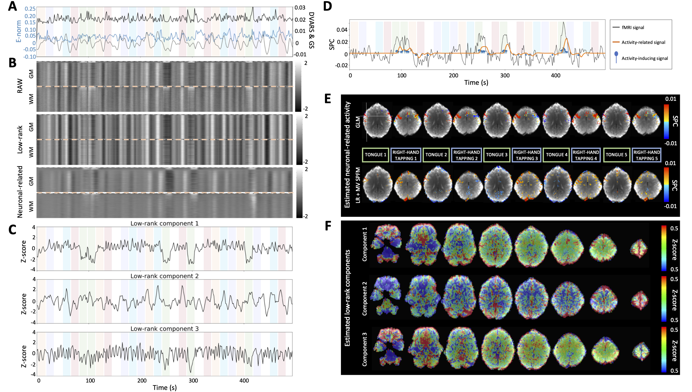 A) Euclidean norm of the motion displacements (E-norm) (blue),
DVARS (black) and global (gray) signals of the fMRI data; B) Grayplots of
gray matter (GM) and white matter (WM) of the preprocessed fMRI
data, the estimated low-rank and neuronal-related components; C) Time series
and F) maps of the estimated low-rank components; D) Time series and E) maps
of representative single-trial neuronal-related (motor) activity. The color
bands in the plots with the time series illustrate the timing of the
different conditions.