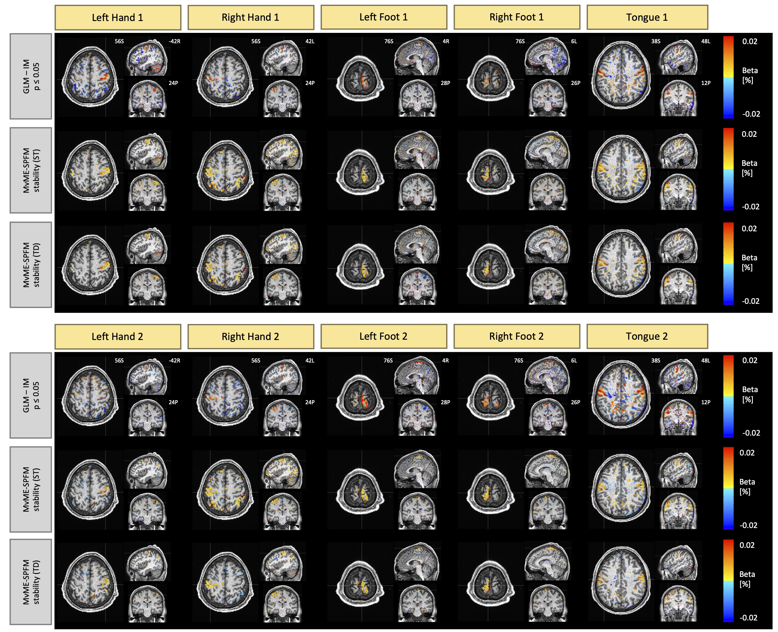 Single-trial activity maps estimated for the single-echo motor task data from the Human Connectome
Project.Row 1 depicts the activation maps obtained with a single-trial GLM (p \leq 0.05), row 2 depicts the maps
detected with the novel Mv-SPFM technique with stability selection, \rho=0.5 and a static threshold (ST), and row
3 illustrates the results using a time-dependent threshold (TD). The activity maps corresponding to the first trial
are shown on top, and the activity maps corresponding to the second trial are shown on the bottom.